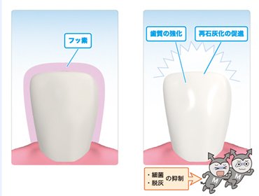 フッ素塗布